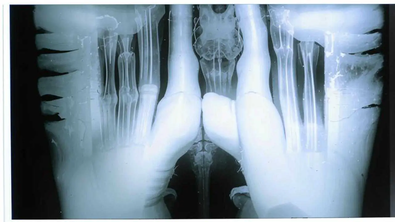 dental fistula on X-ray