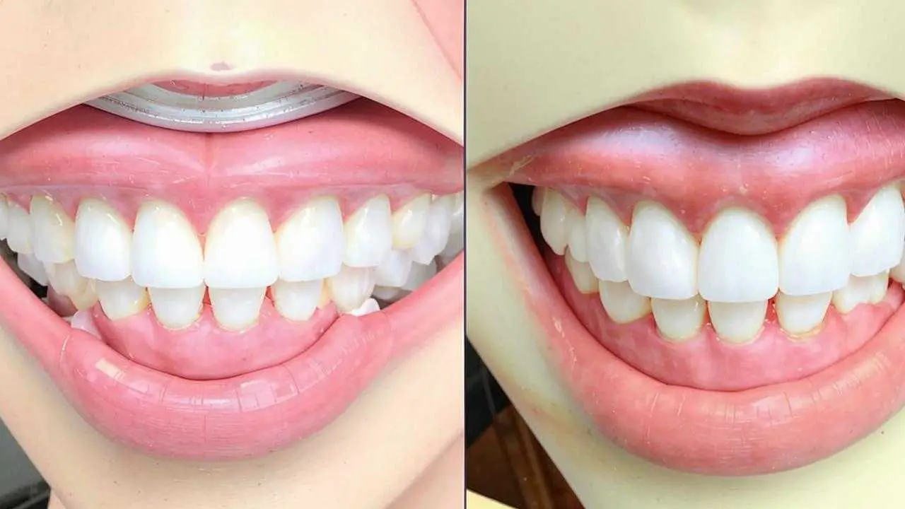 after-bleaching example