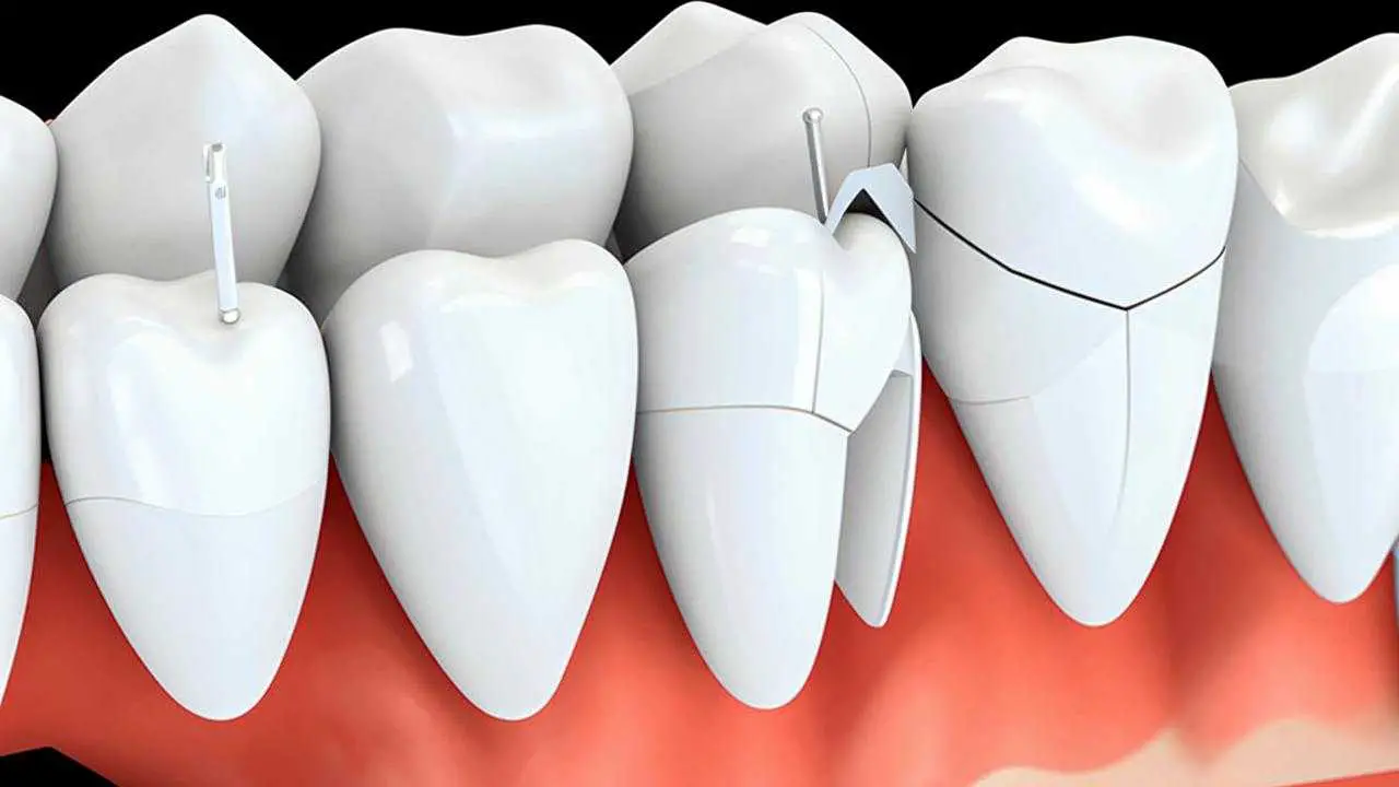 enamel microcracks