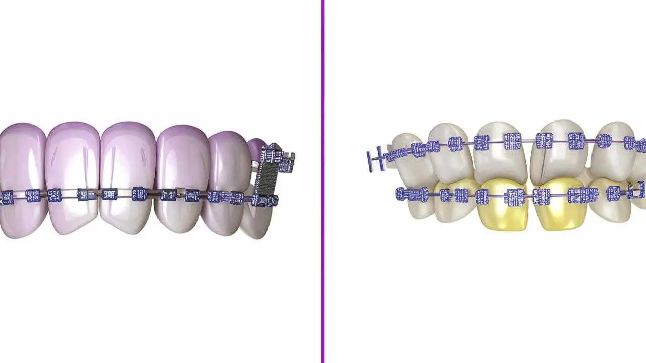 differences between ceramic and sapphire braces