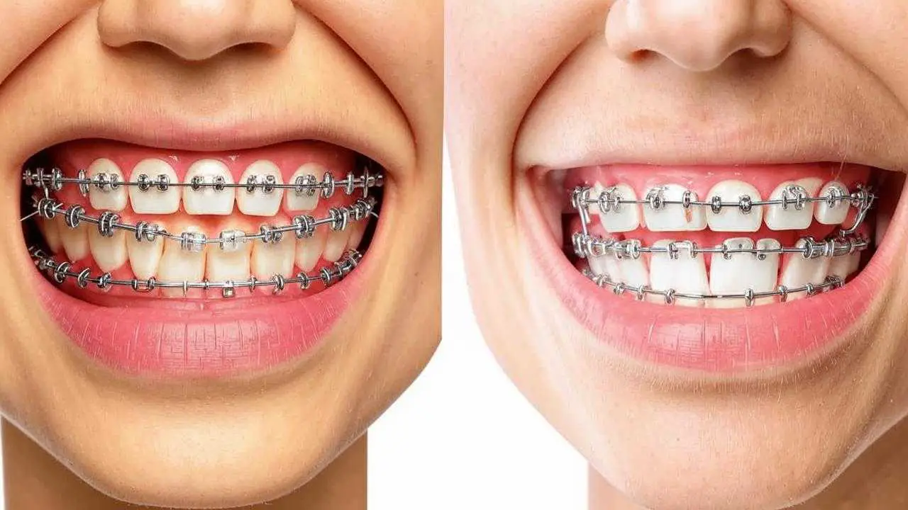 differences between eliners and braces