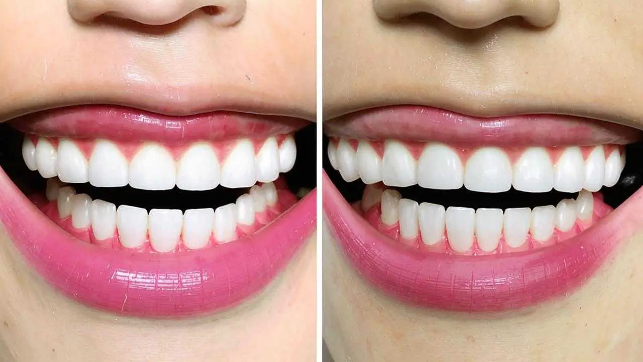 Before and after photos of veneers at ROOTT