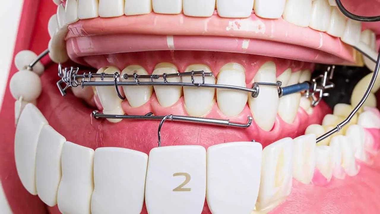 dental splinting