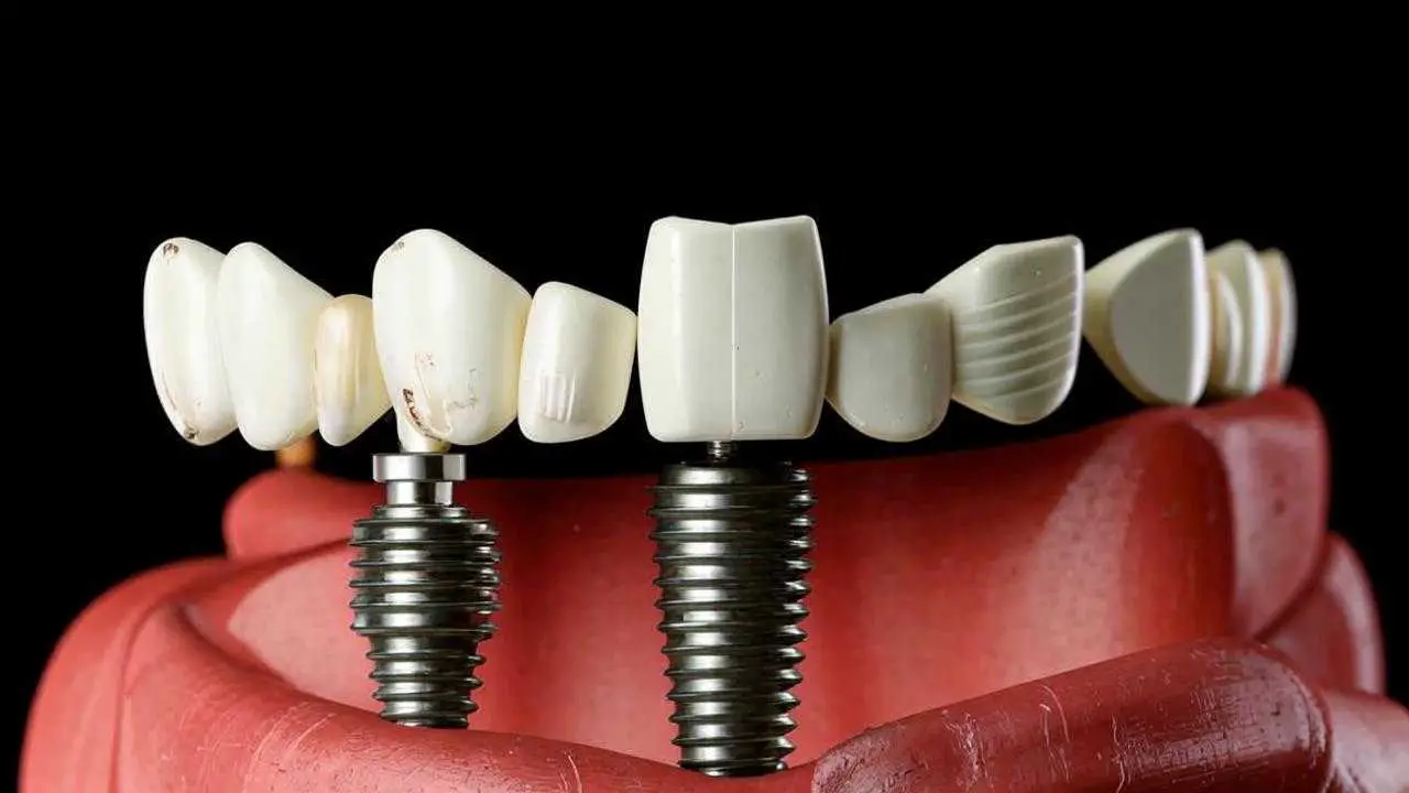 Which is better - implant or dentures