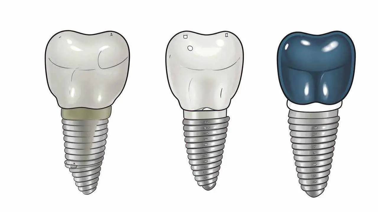 Astra Tech Dental Implants (Astra Tech)